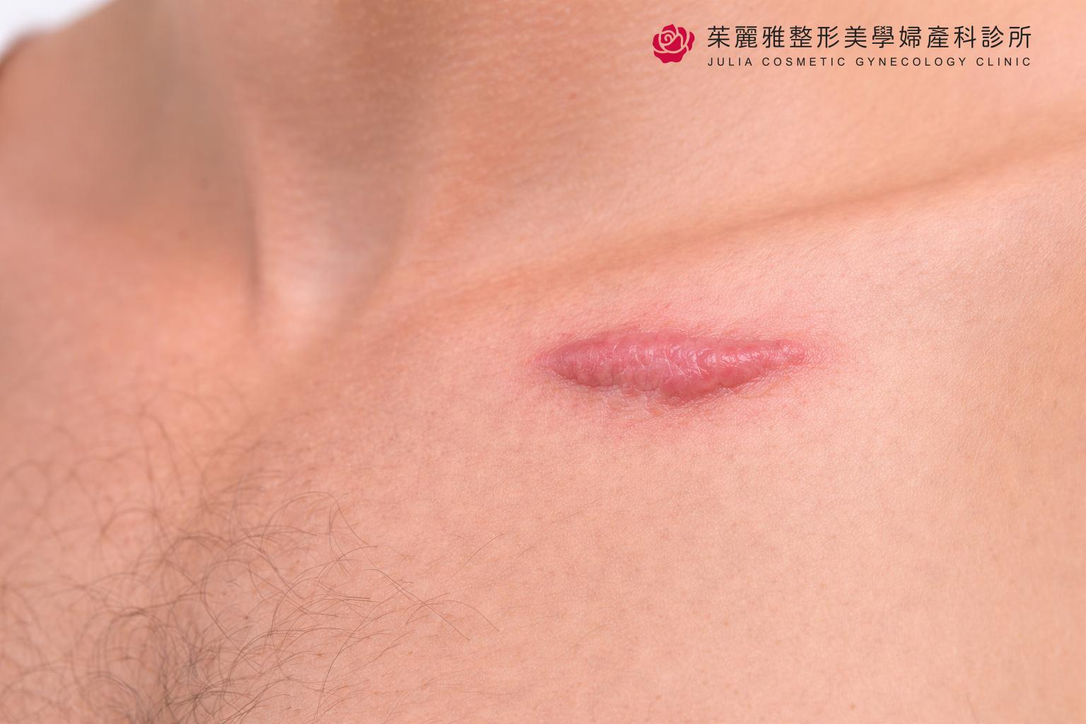 蟹足腫疤痕凸起示意圖