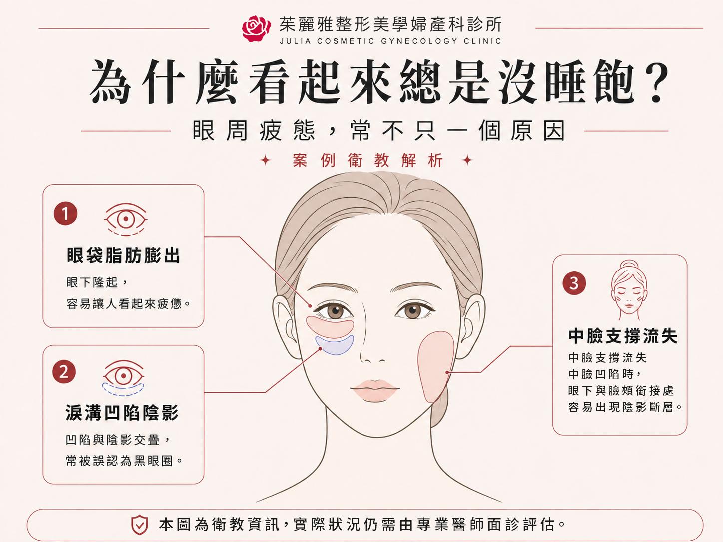 眼袋脂肪 淚溝凹陷