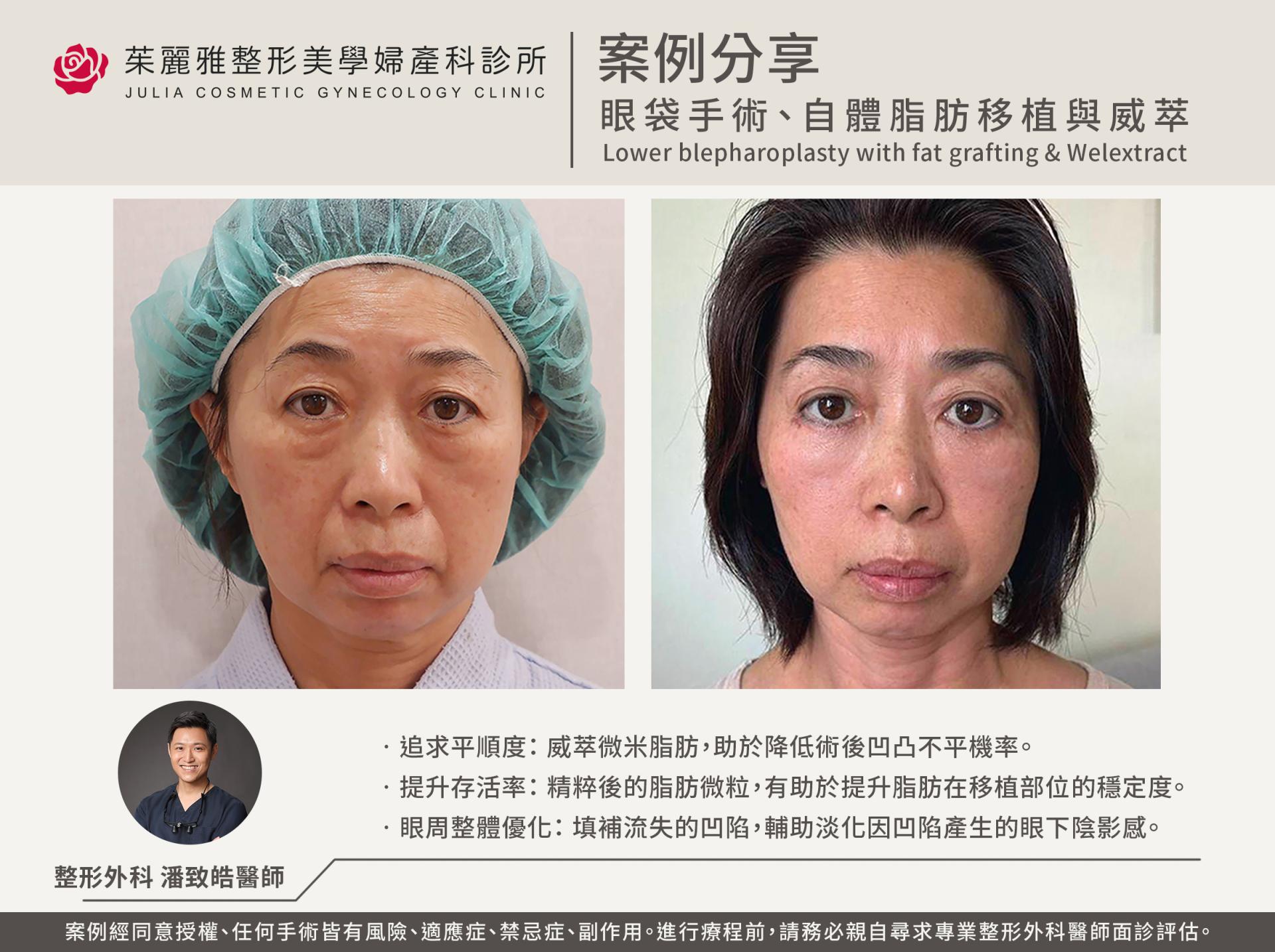 茱麗雅醫美潘致皓醫師眼袋手術威萃自體脂肪移植案例