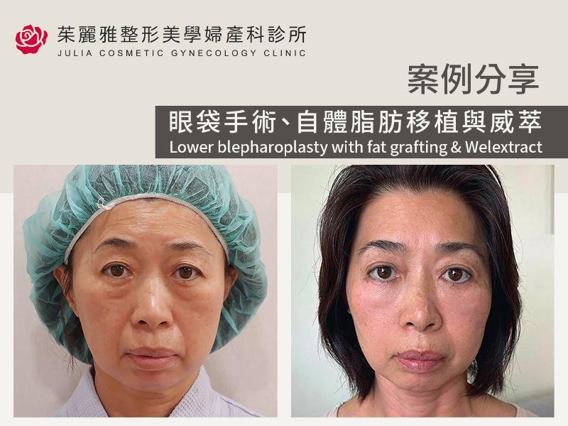 【眼袋手術案例】找回眼神流暢神采！整形外科潘致皓醫師以複合式規劃重塑中臉平順度